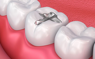 Amalgam Fillings