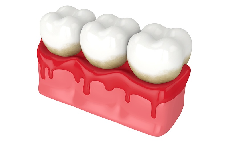 Bleeding Gums