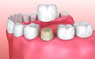 Ceremic or Porcelain Crown Ceramic or Porcelain