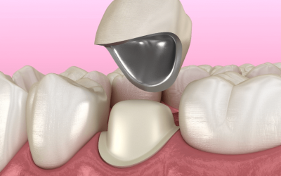 PFM Porcelain-Fused-to-Metal (PFM)
