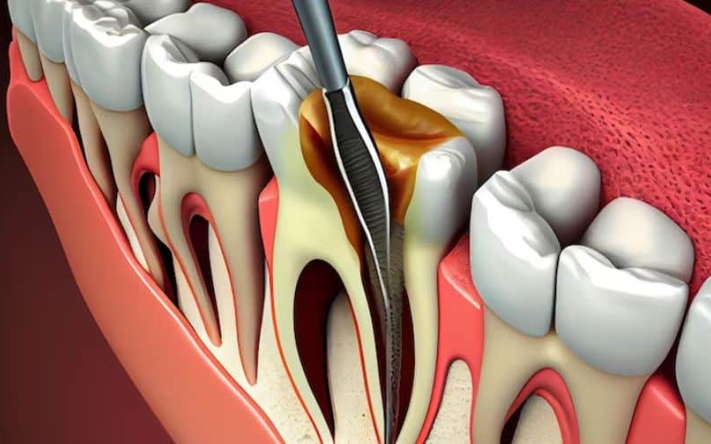 Root Canal (1) Root Canals
