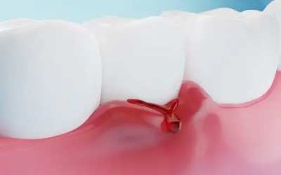 Swollen Gums (1) Swollen Gums