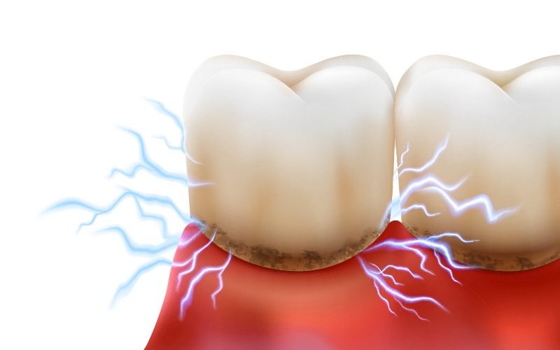 Tooth Sensitivity