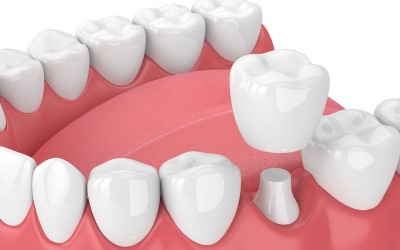 Zirconia Crown Zirconia