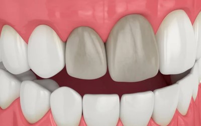 depositphotos_383929602-stock-photo-render-jaw-upper-incisor-teeth Tooth Darkening