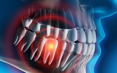tooth-pain-xray(1) Severe Pain