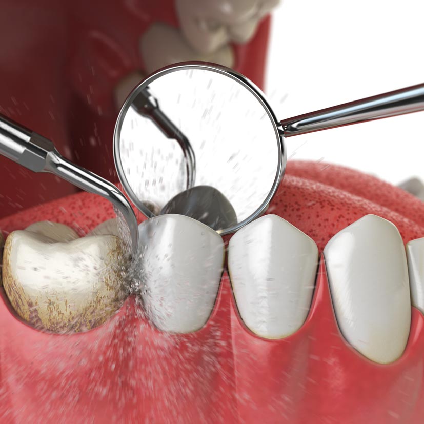 Regular Dental Cleanings